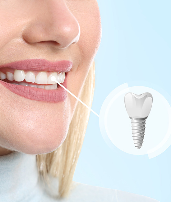 The image shows a woman with a smile, featuring a dental implant, with a sticker of the same implant on her nose.